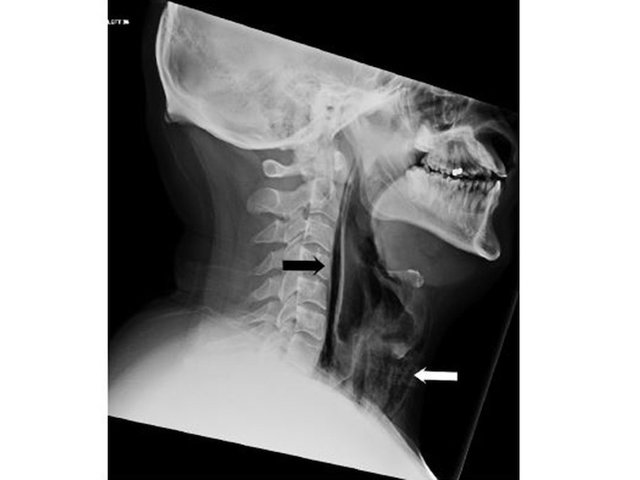 Holding in a sneeze caused hole to open in man's neck